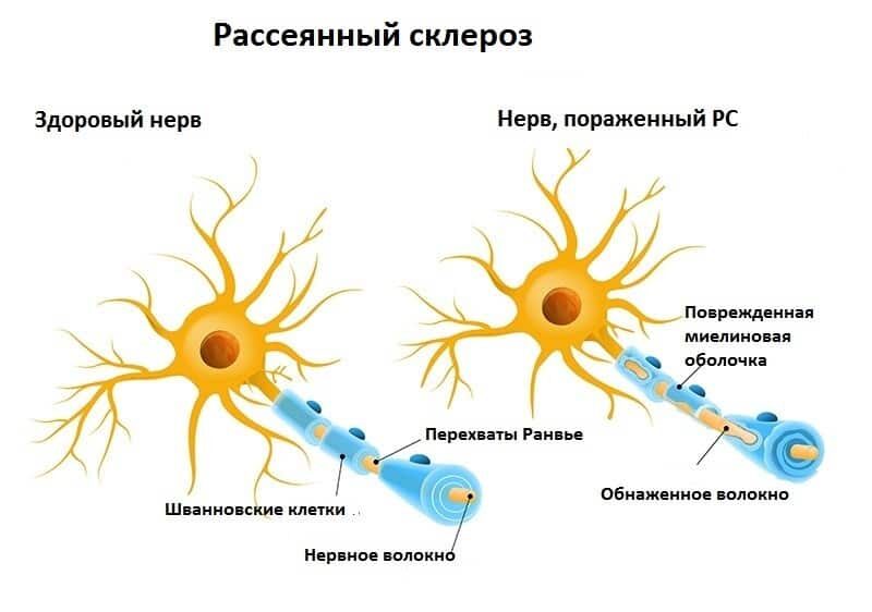 sclerosis-9065385