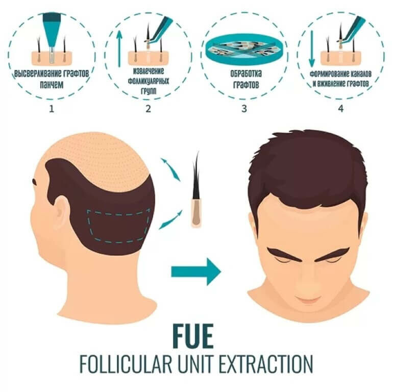 hair_transplantation_4-6905809