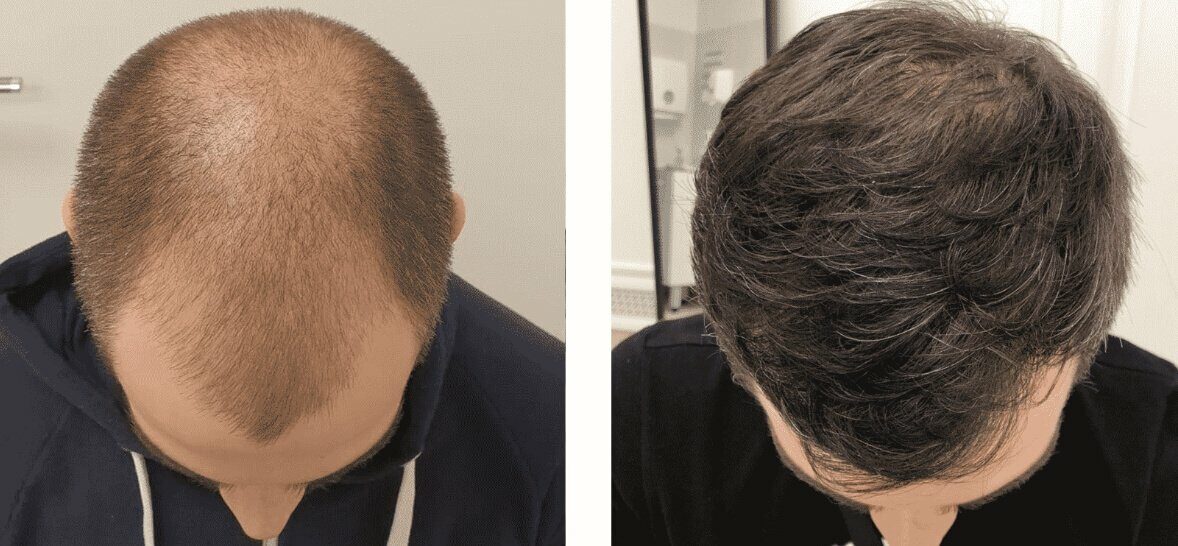 hair_transplantation_6-1-1613634